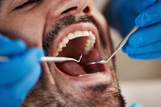 Best Emergency Wisdom Tooth Extraction in Cane Savannah, SC