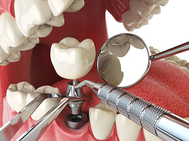 Best Emergency Root Canal Therapy in Cane Savannah, SC